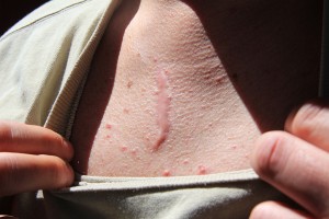 “Tom” shows the three-inch knife scar he received while raiding the human trafficking ring to save scores of children. The knife glanced off his sternum and did little damage.